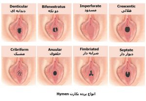 Different forms of hymen