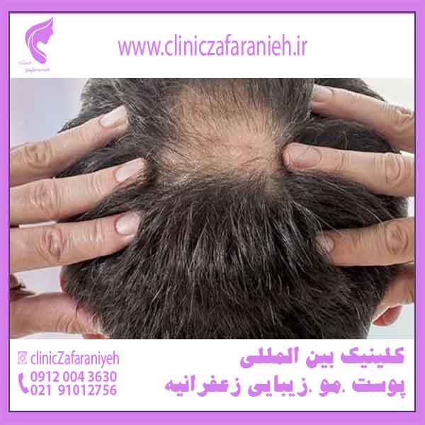 جلوگیری از ریزش مو _  راهکار های موثر در درمان ریزش مو