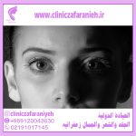 Complications of Upper Eyelid Surgery